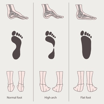 diagram of what causes flat foot