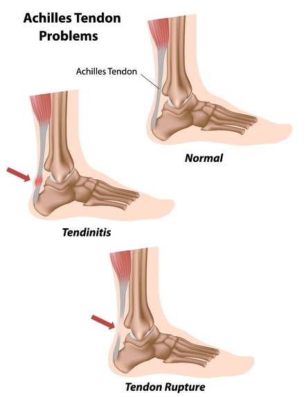 Achilles Tendon Diagram Extend Orthopedics
