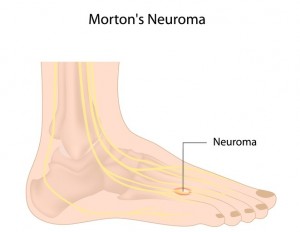 Mortons neuroma