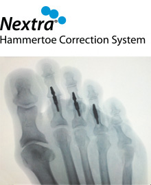 hammertoe correction surgery Nextra