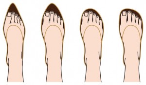 wearing tight shoes is a risk factor for Morton's neuroma