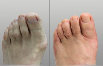 before and after bunion surgery