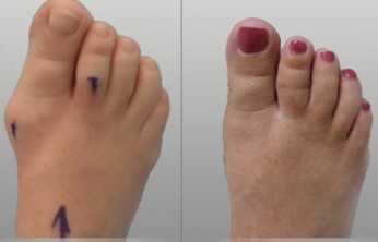 before and after bunion surgery images